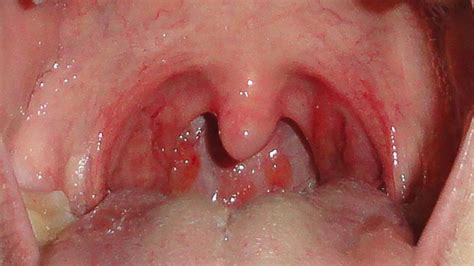 Sore Throat Causes Symptoms Diagnosis Treatment Prevention