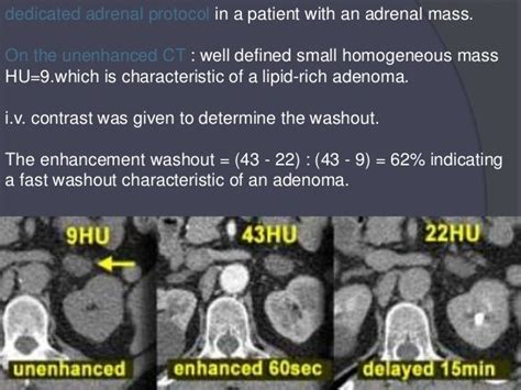 Mri And Ct Of Adrenal Gland