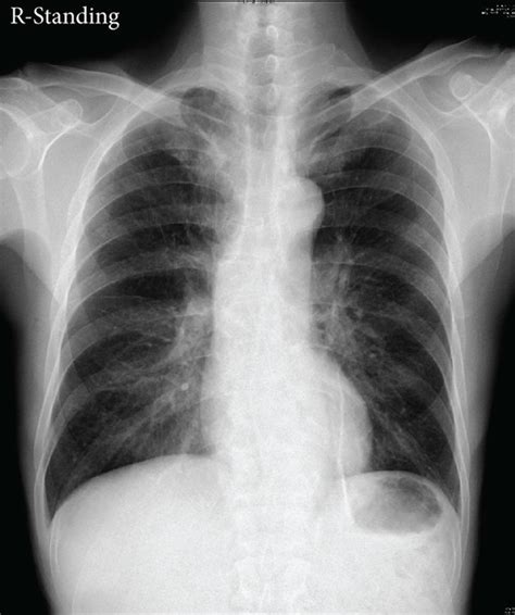 Unremarkable Chest X Ray At A Mania Onset And B 2 Years Later With