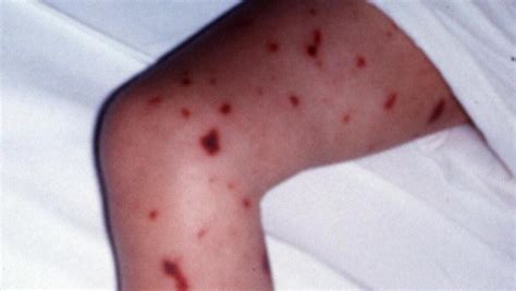 Two New Meningococcal Cases In Wa As Tally Hits 13 Perth Now