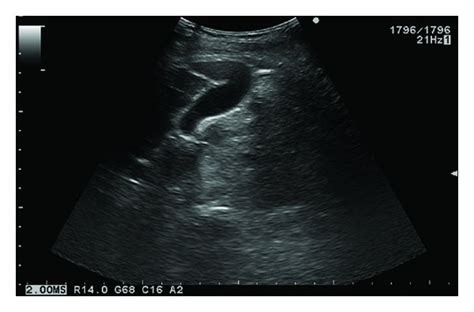 Long Axis View Of The Gallbladder Shows It Extending From The Hilum To