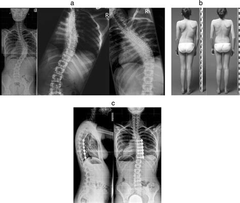 “bone οn Bone” Surgical Reconstruction Of Moderate Severity Flexible Single Curve Adolescent