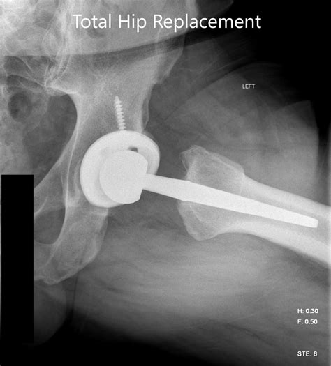 Case Study Left Hip Total Replacement In 54 Year Old Female