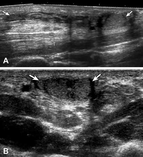Ultrasound Features Of Palmar Fibromatosis Or Dupuytren Contracture