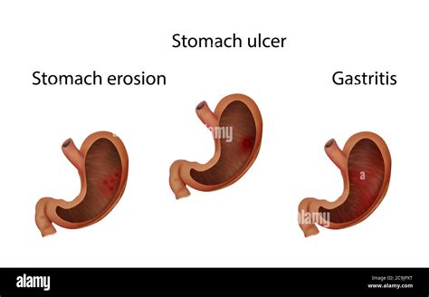 Gastritis Stomach Ulcer And Stomach Erosion Illustration Stock Photo