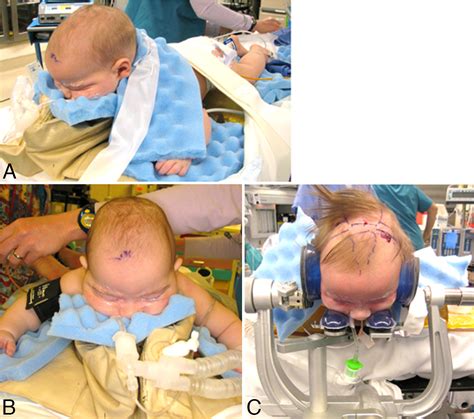 One Hundred Consecutive Endoscopic Repairs Of Sagittal Craniosynostosis