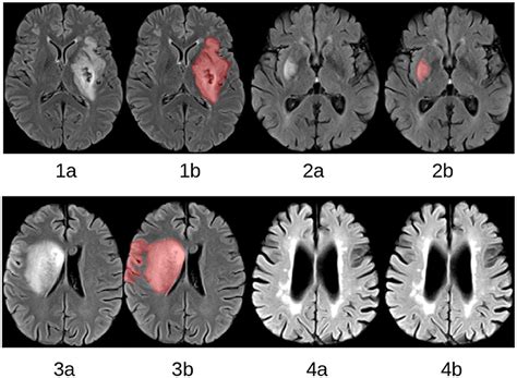 Brain Stroke The Way A Stroke Affects The Brain Depends On Which Part