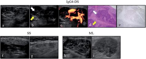 Sonographic Features Of The Submandibular Gland Smg From
