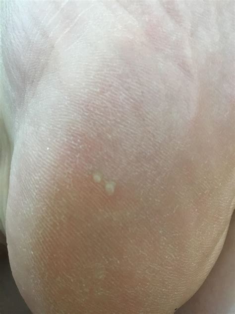 Are These Little White Bumps Warts I Have 7 Total Rwarts