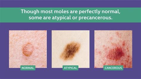 What Does An Unhealthy Mole Look Like Spotting Warning Signs