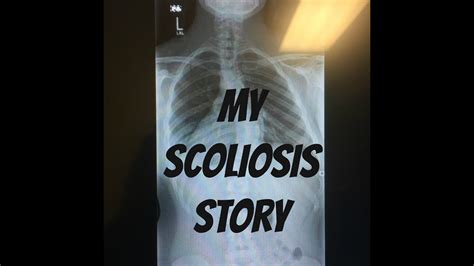My Scoliosis Story Surgery Advice Youtube