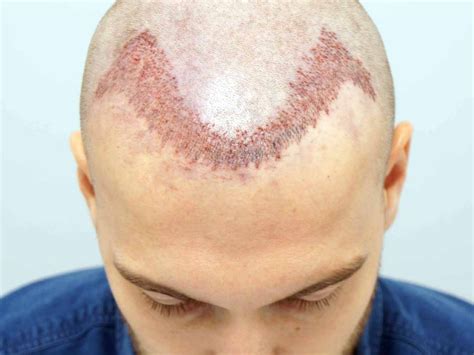 El Trasplante Capilar Y Sus Fases Todo Sobre Alopecia My XXX Hot Girl