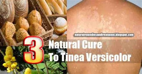 What Is Best Treatment For Tinea Versicolor