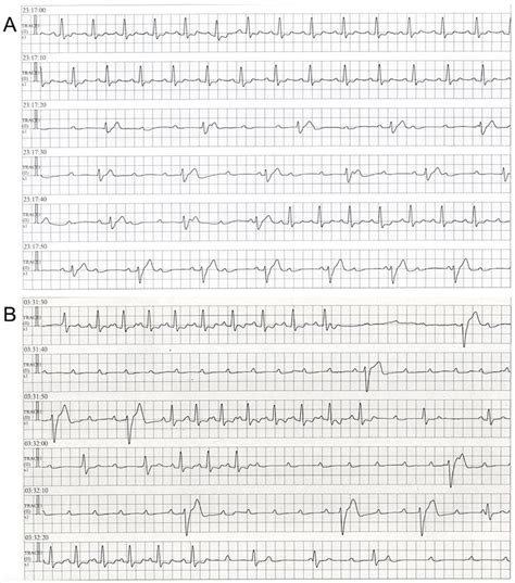Rhythm Strips Of Continuous Electrocardiograms From Bedside Cardiac