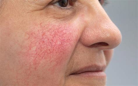 Rosacea Causes And Treatment Dr Walias Skin And Laser Clinic