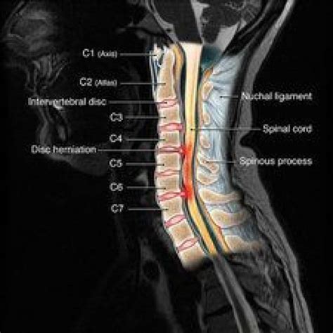 Cervical Spine Injury Mri Illustration Backpain Radiology Medical