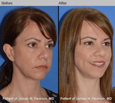 Mid Face Lift Cheek Lift Photos Before And After Dr James Pearson