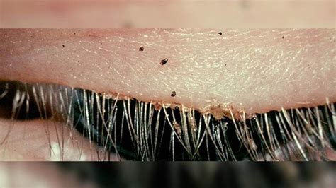 Uptick In Cases Of Eyelash Lice Prompt Doctor Warnings