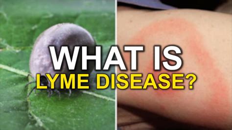 What Are The Symptoms Of Lyme Disease How Do You Get It And Is There A