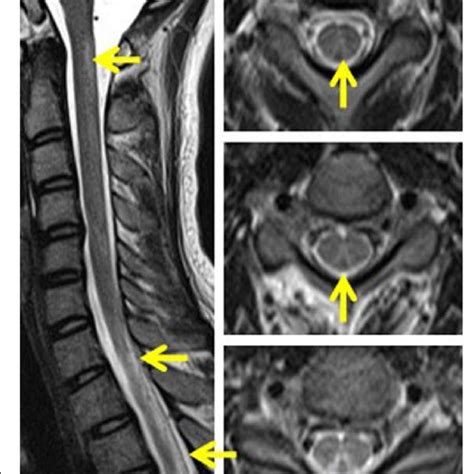 The Mri Of Spinal Cord Showed Abnormal Hyperintensities Within The