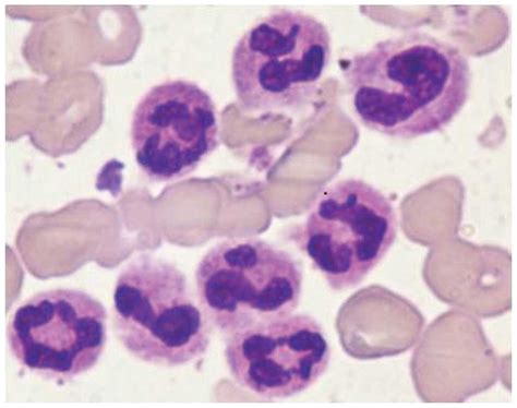 Diagnosis Complications And Management Of Chronic Neutrophilic