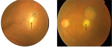 Ocular Toxoplasmosis