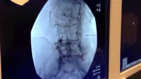 Bilateral Transforaminal Epidural Steroid Injection Offered In Las