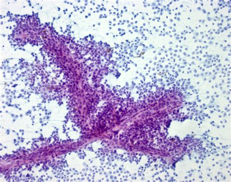 Pathology Outlines Metastatic Melanoma