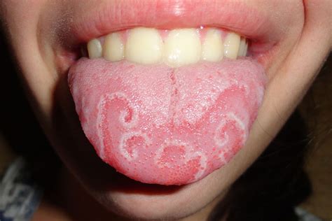 Small Big Sore Red Spots On Tongue Cause Meaning American Celiac