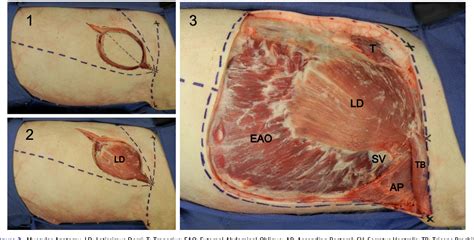 Figure From Latissimus Dorsi Myocutaneous Flap Procedure In A Swine