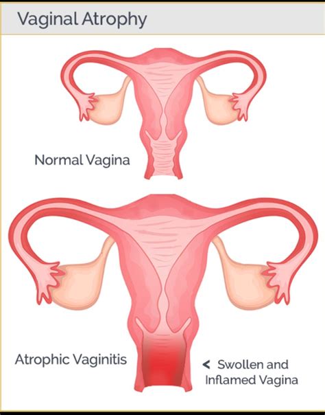 An Overview Of Atrophic Vaginitis Platform CME