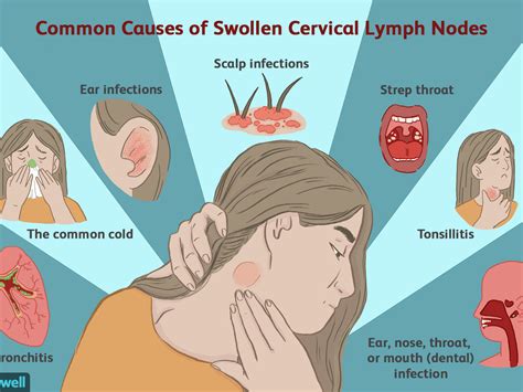 Throat Cancer Swollen Lymph Nodes Swollen Cervical Lymph Nodes What