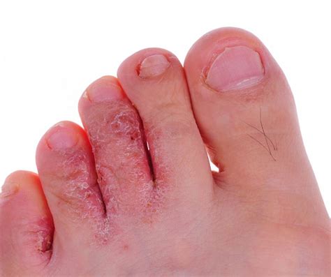 why are my feet peeling 4 causes complete guide 2023 why are my feet peeling 4 causes