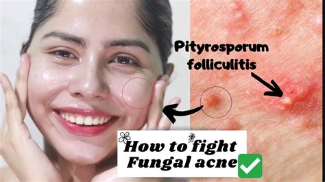 5 Ways To Get Rid Of Fungal Acne Effectively Youtube