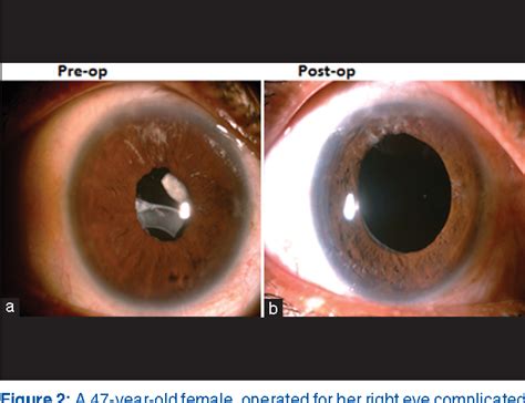Figure 2 From Late Dislocation Of In The Bag Intraocular Lenses In