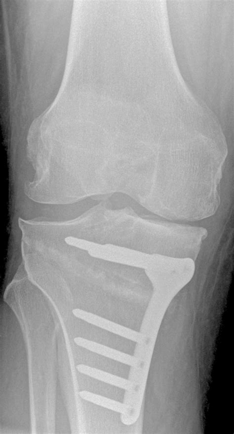 High Tibial Osteotomy In Combination With Arthroscopic Abrasion