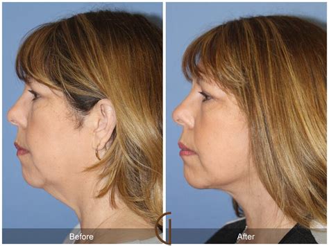Neck Lift Before And After Photos Patient 97 Dr Kevin Sadati