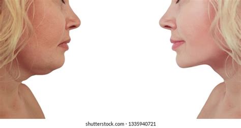 Woman Double Chin Before After Procedures Stock Photo 1335940721