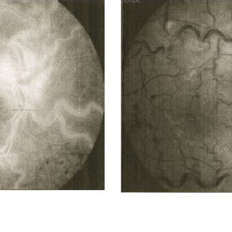 Central Retinal Vein Occlusion Fluorescein Angiography A And Photo Download Scientific