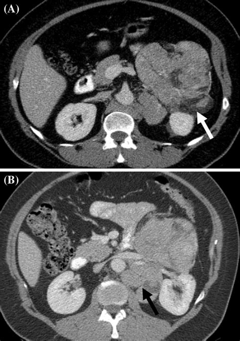 Axial Contrast Enhanced Abdominal Ct A And B Shows A Large Mass In