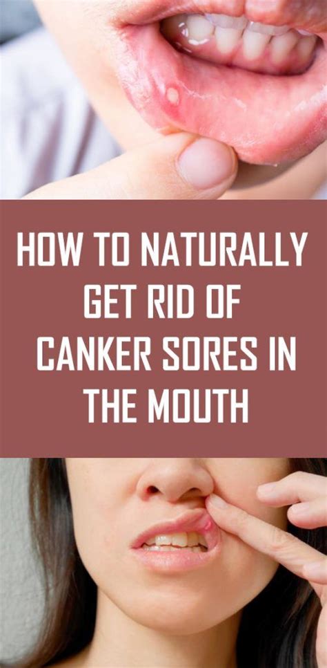 How To Naturally Get Rid Of Canker Sores In The Mouth Mouth Health