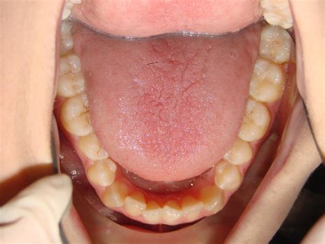 Occlusal Photo Of Mandibular Dentition Nuss Birn Flickr