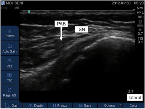 Pes Anserine Bursa PAB Lies Under The Pes Anserine Tendons SN Download Scientific Diagram