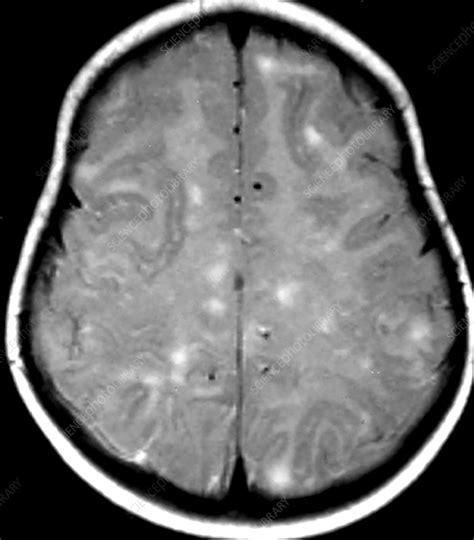 Mri Of Adem Stock Image C0435532 Science Photo Library