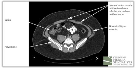 Hernia Types Umbilical California Hernia Specialists