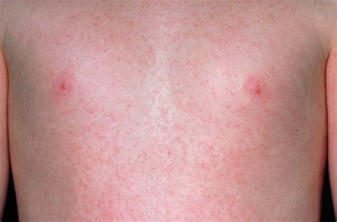 What Is Scarlet Fever Everything Parents Need To Know Metro News