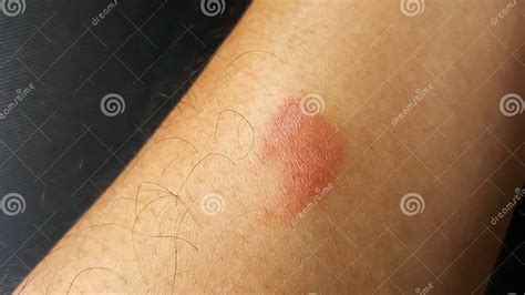 Close Up Centipede Bite Poisonous Hurt Arm Stock Photo Image Of