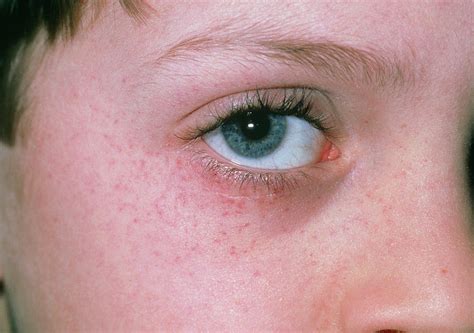 Purpura Rash On Childs Face After Vomiting Photograph By Dr P Marazzi