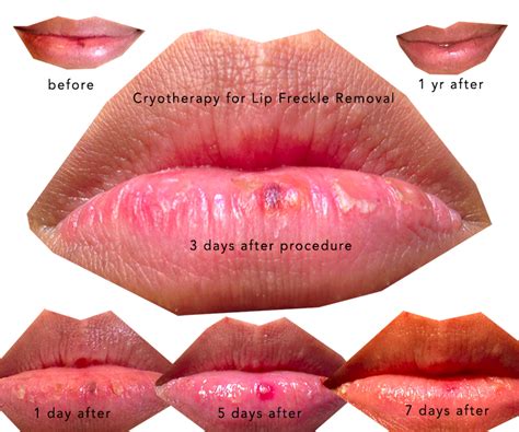 My Lip Freckle Removal Story