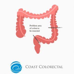 Professional Colorectal Surgeons In The Gold Coast And Tweed Diverticular Disease